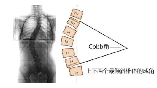 脊柱側(cè)彎角度怎么測量？