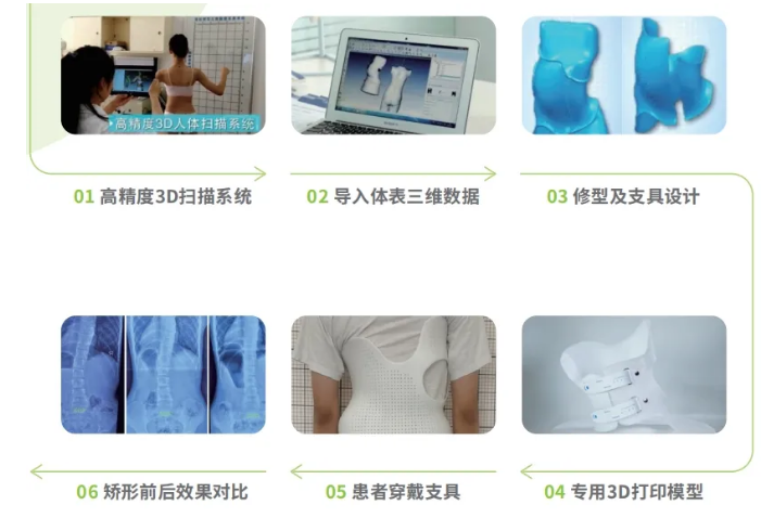 傳統(tǒng)脊柱側彎支具與3D打印矯形支具的區(qū)別  